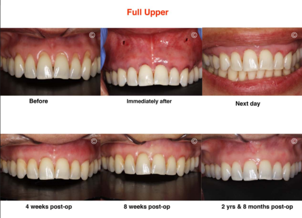 Pinhole Gum Rejuvenation Dental Gum Restoration In Alhambra Ca