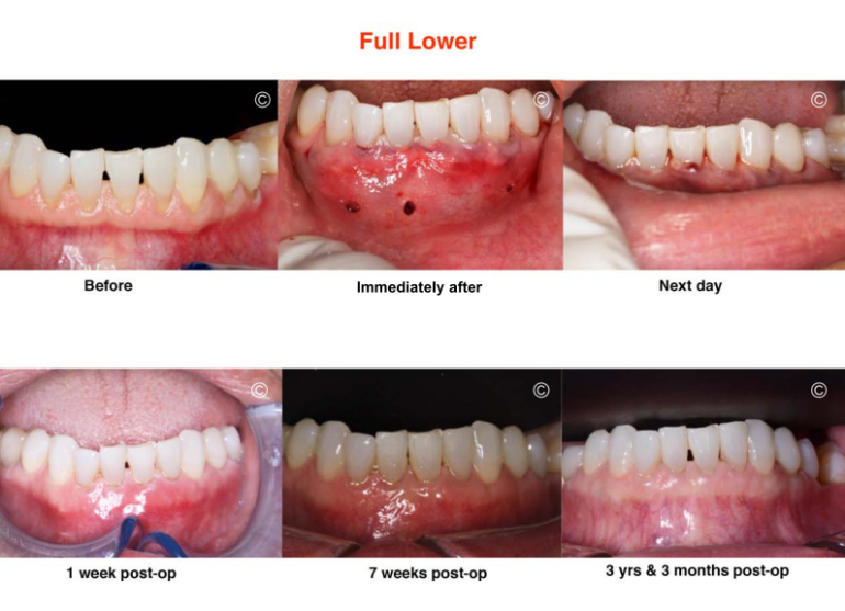 Pinhole Gum Rejuvenation® Dental Gum Restoration in Alhambra, CA