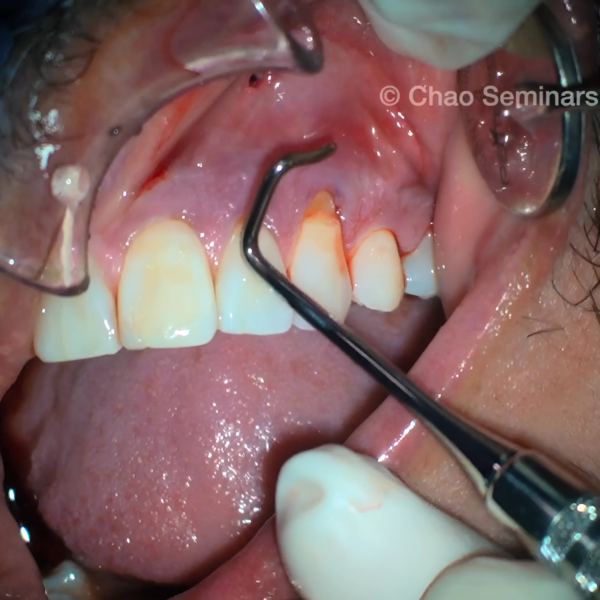 lose-up of a clinician performing the Pinhole Surgical Technique® for gum recession treatmen