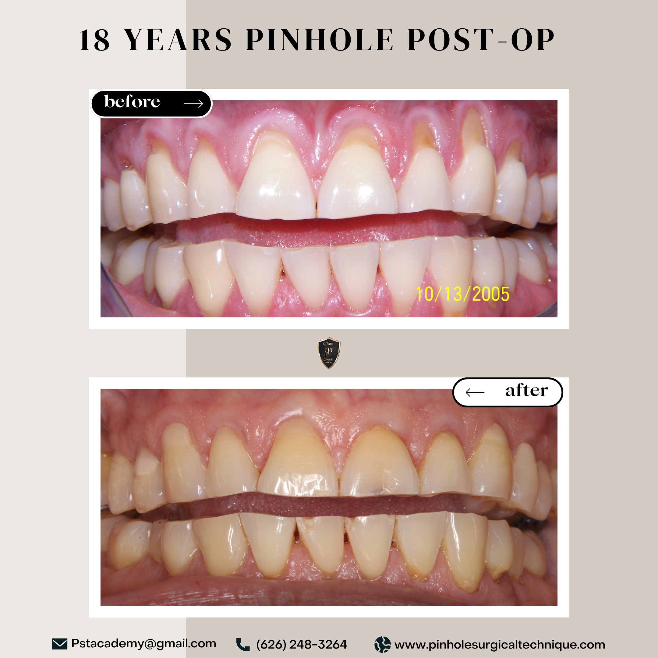 Before and after photos showing 18 years post-op results of the Pinhole Surgical Technique for gum recession treatment