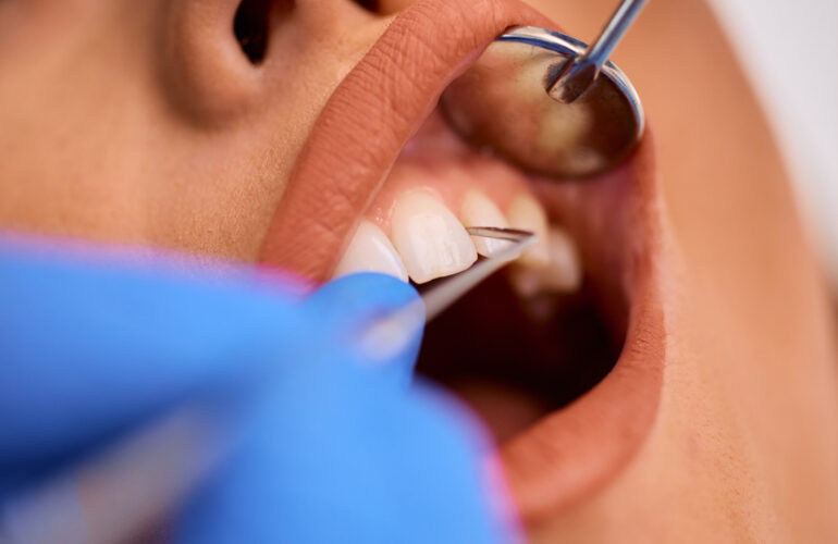 Close-up of a patient undergoing a dental procedure, with a focus on the gums and teeth as a dentist uses specialized tools to evaluate gum health.