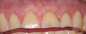 Coverage maintained at long-term follow-up