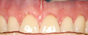 Coverage after treatment